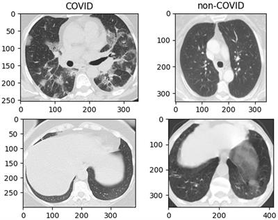 Optimization of pneumonia CT classification model using RepVGG and spatial attention features